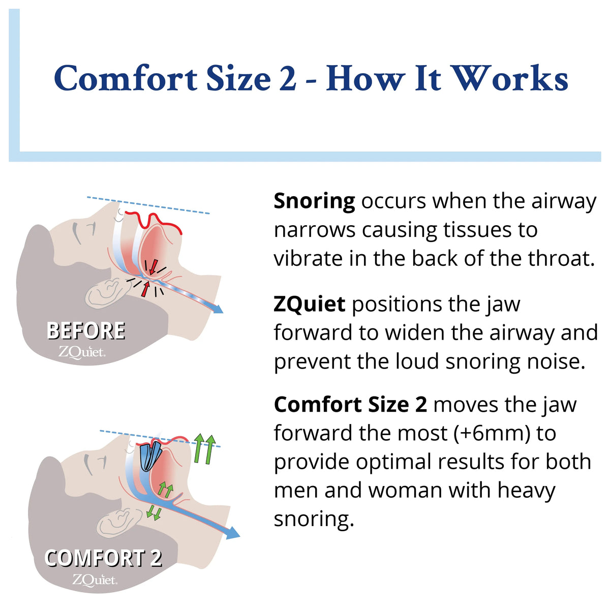 Comfort Size #2 Anti-Snoring Mouthpiece (Clear) F796